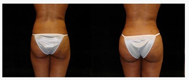 你的自體脂肪能“搬”到哪兒？