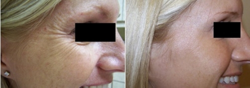 2個品牌瘦臉除皺 除皺要哪個