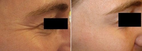 2個品牌瘦臉除皺 除皺要哪個