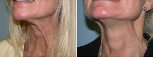 2個品牌瘦臉除皺 除皺要哪個