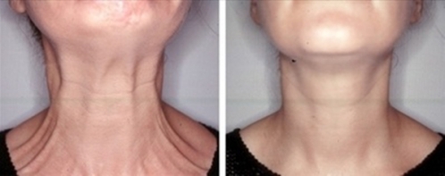 2個品牌瘦臉除皺 除皺要哪個