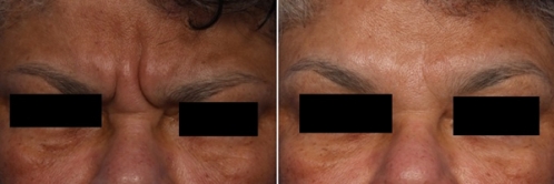 2個品牌瘦臉除皺 除皺要哪個