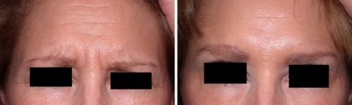 2個品牌瘦臉除皺 除皺要哪個