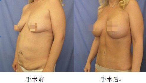 產(chǎn)后媽媽大變身 S曲線畢露無(wú)遺