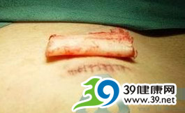 自體真皮隆鼻pk假體隆鼻