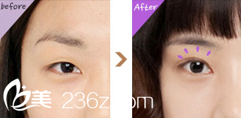 雙眼皮對比圖