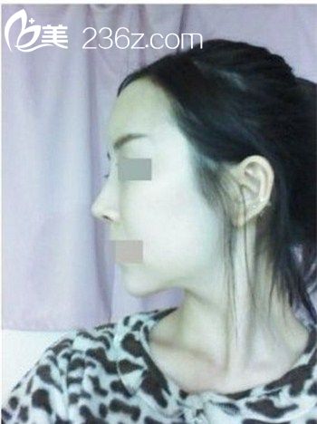 自體脂肪豐額頭