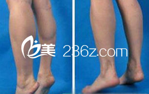 瘦臉除皺瘦小腿