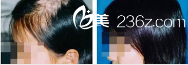 疤痕植發(fā)案例