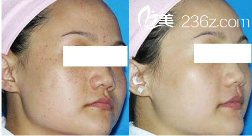 激光祛斑案例