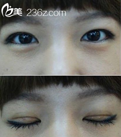 切開法雙眼皮效果對(duì)比