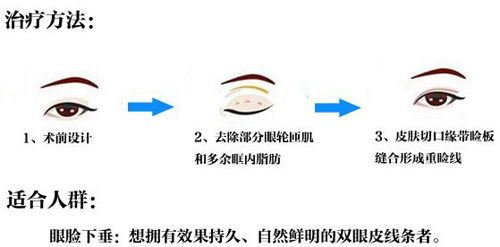 切開法雙眼皮的過程