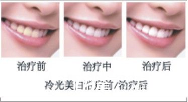冷光美白的效果