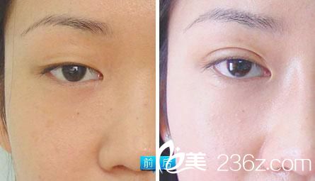 重瞼術(shù)效果圖