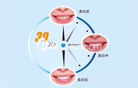 冷光美白只需30分鐘