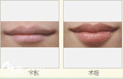 注射自體脂肪豐唇