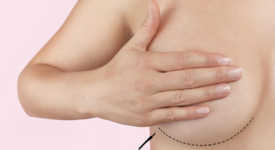 水滴狀胸部整形