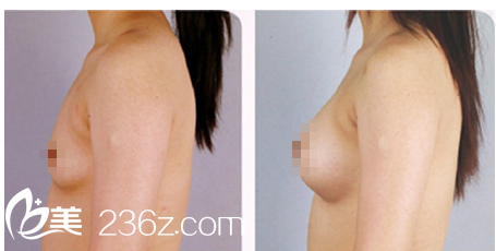 水滴狀假體隆胸效果對(duì)比圖