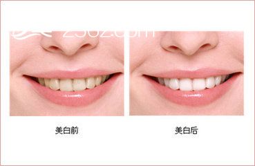 皓齒美白，給你一口健康好牙