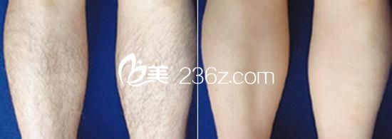 濟(jì)南冰點(diǎn)脫毛術(shù)前術(shù)后對比圖