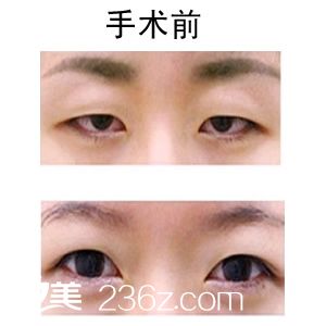 開眼角的對比圖