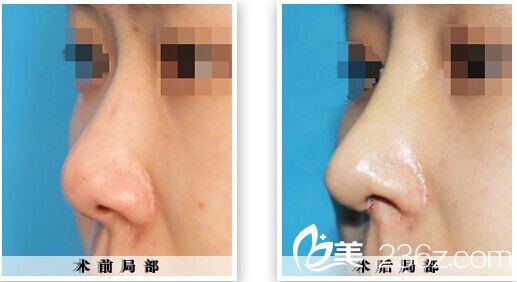 鼻翼縮小術(shù)整形