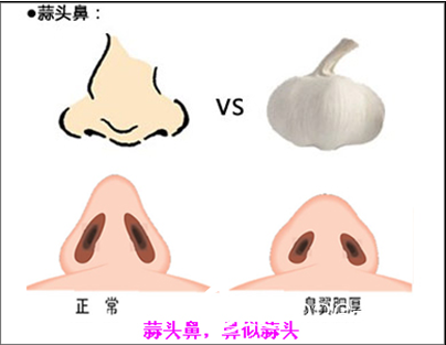 蒜頭鼻