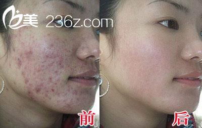 激光去痘疤的效果