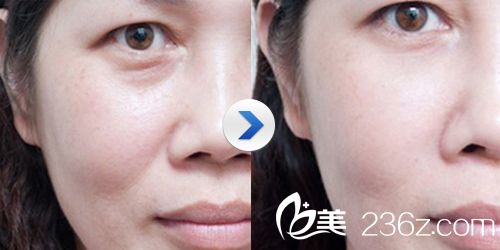 注射玻尿酸填充淚溝的注意事項(xiàng)