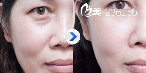 開眼角前后對比圖