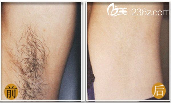 全身冰點(diǎn)脫毛前后對比圖