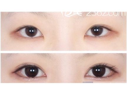 開內(nèi)眼角效果圖
