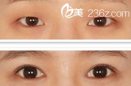 開內(nèi)眼角效果圖