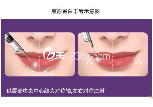 膠原蛋白注射豐唇