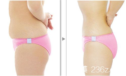 吸脂瘦腹部
