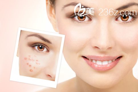 激光去痘手術(shù)