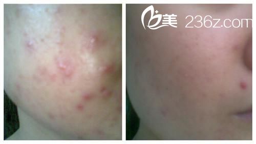 激光去痘手術(shù)前后對比圖