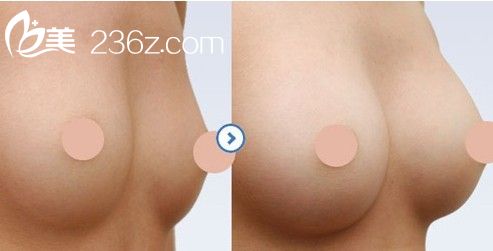 韓式隆胸價(jià)格