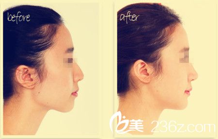 玻尿酸隆鼻前后對(duì)比圖