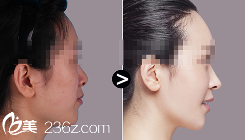 墊鼻子手術(shù)前后對比圖