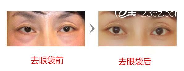 去眼袋前后效果圖