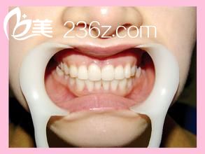 烤瓷牙也有副作用，并非人人都適合！