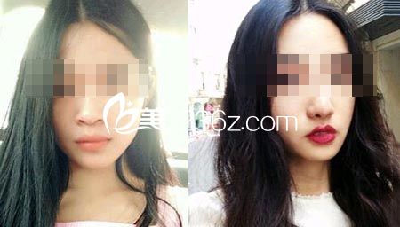 蒜頭鼻整形前后對(duì)比照片 蒜頭鼻整形前后對(duì)比照片