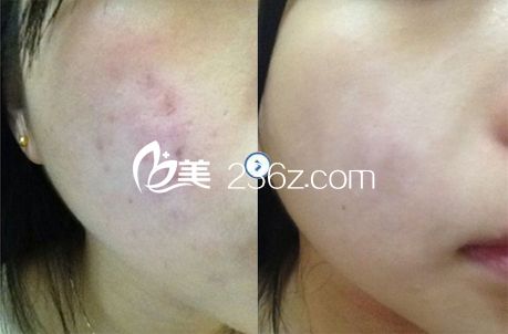 點(diǎn)陣激光去痘印效果