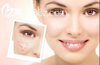 北京點(diǎn)陣激光去痘印有副作用嗎？