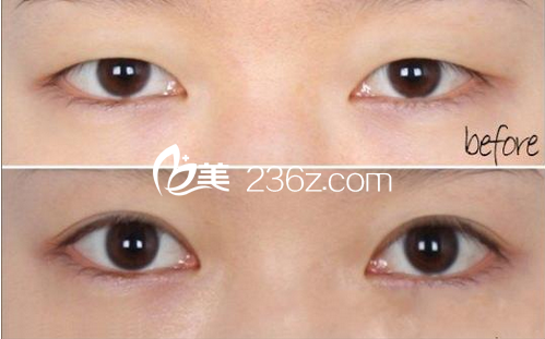 韓式三點雙眼皮術(shù)后對比圖