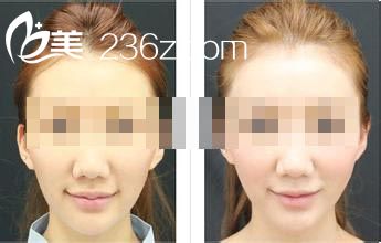 埋線雙眼皮恢復(fù)時間