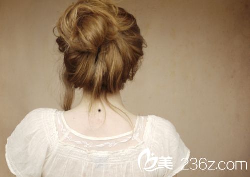 先天性巨痣應(yīng)該及時(shí)治療