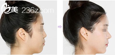 注射隆鼻手術(shù)前后對比圖