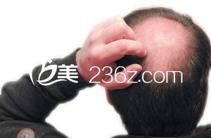 禿頂?shù)脑蚴鞘裁?？禿頂能醫(yī)治嗎？